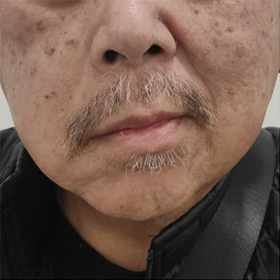 antes a paralisis facial