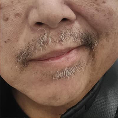 antes b paralisis facial