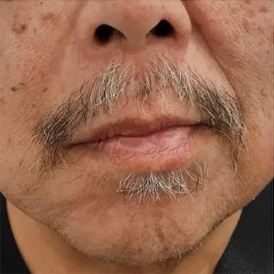 despues a paralisis facial