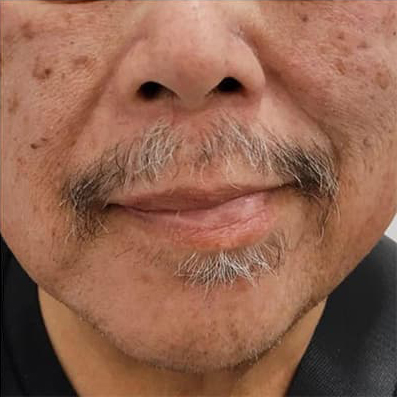 despues b paralisis facial