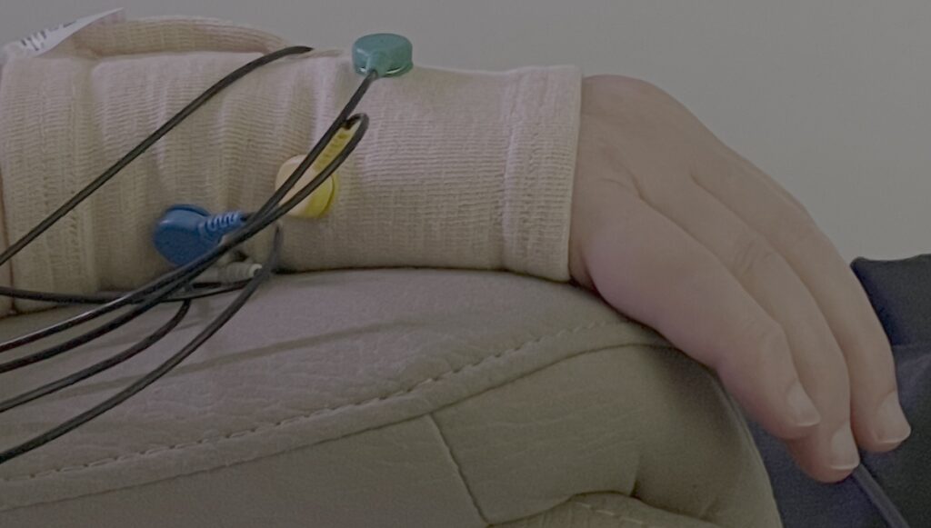 Detalle de electrodos colocados en la muñeca durante un tratamiento de neuromodulación no invasiva